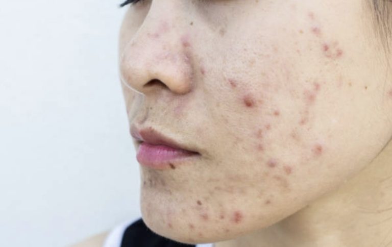 Find Out How to Get Rid of a Pimple OverNight