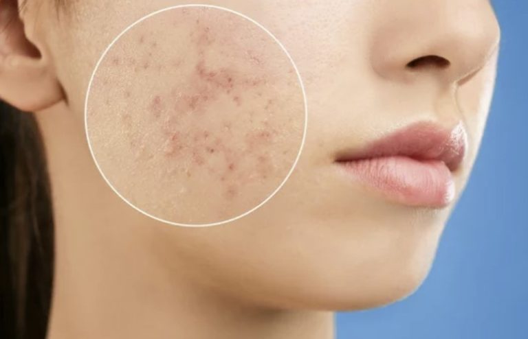 Easy Zit Treatment to Cope with the Skin Problems