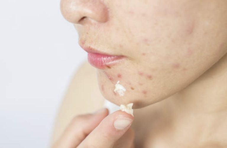 How to Get Rid of a Pimple Overnight: 4 Quick Recommendations