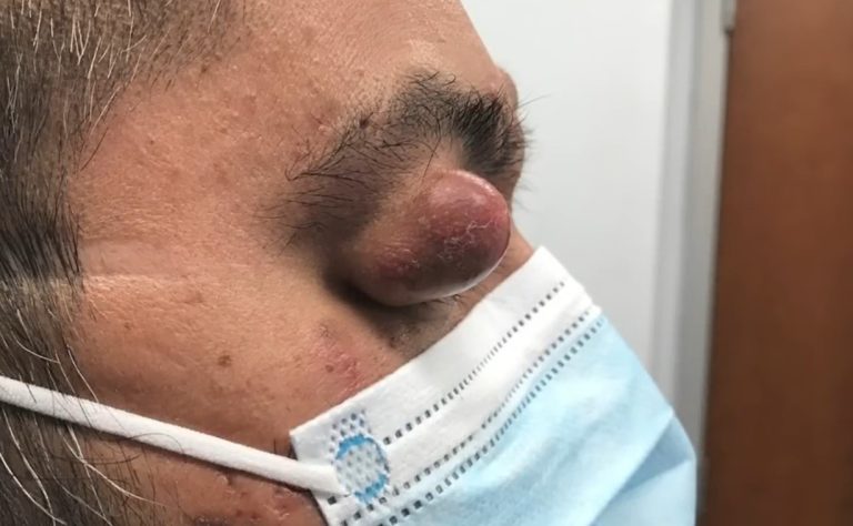 Acne Scars and Dark Marks: Types and Treatment Options